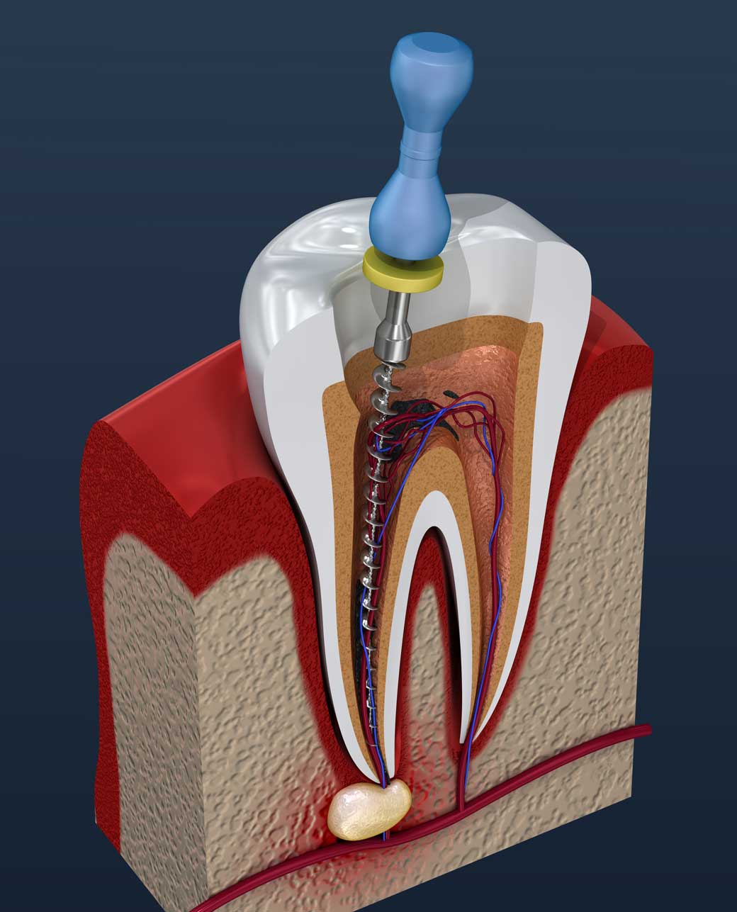Safe Alternatives to Root Canals in Holistic Dentistry