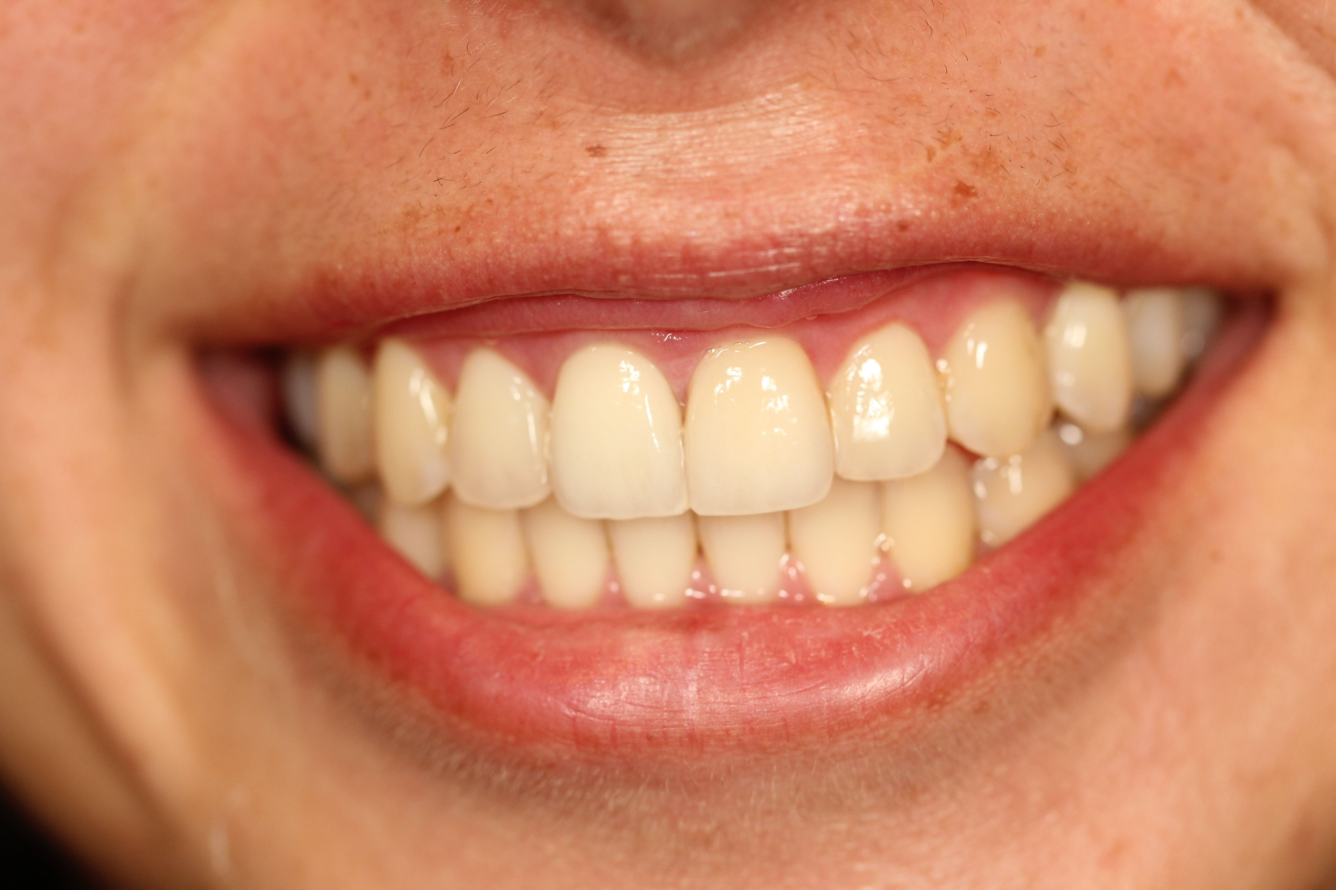 Before & After: Correction to Dental Veneers 