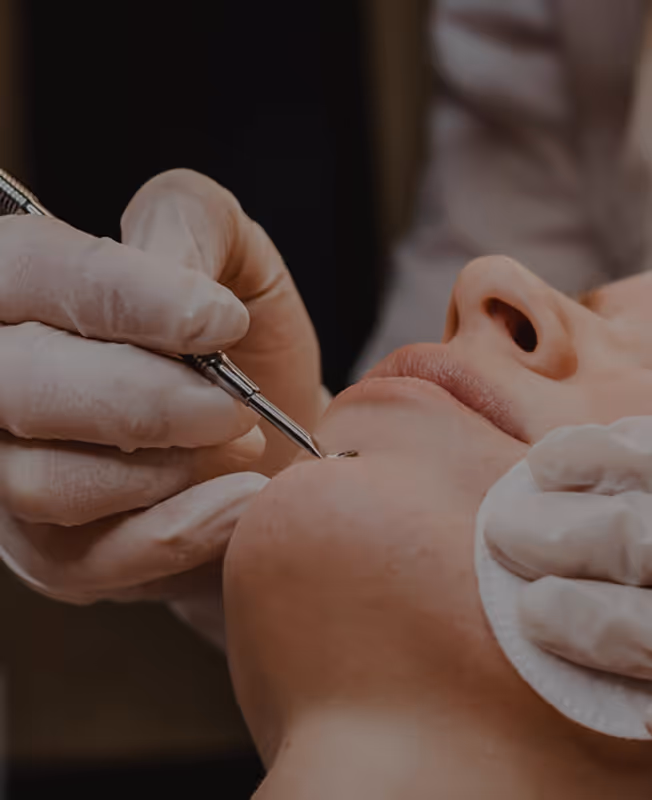 Close-up of a cosmetic procedure being performed on a person's chin with a metal tool by a gloved professional.