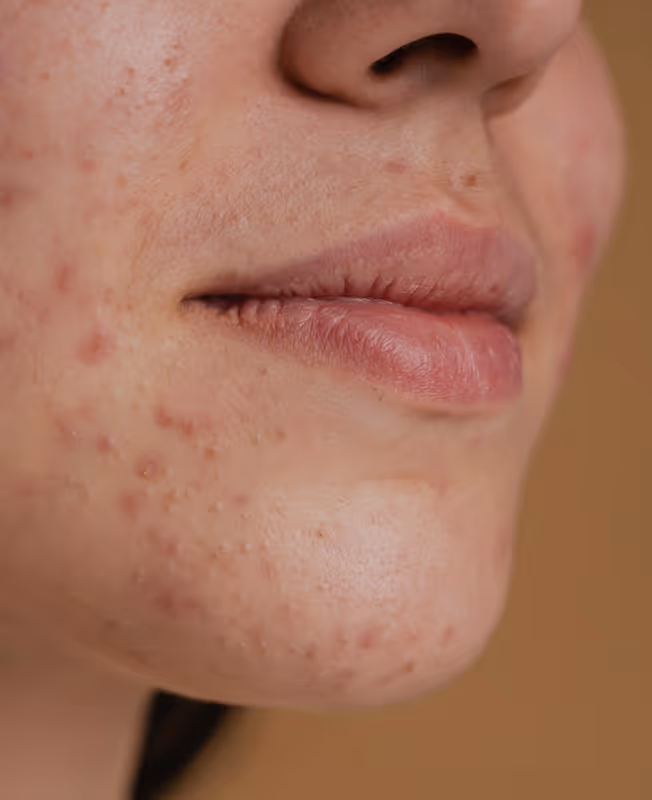 Close-up of a person's lower face with visible acne and natural lips.