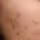 Close-up of a person’s cheek with multiple acne spots and blemishes.