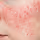 Close-up of cheek with red acne and inflamed skin.