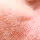 Close-up of a person's chin and lower cheek showing stubble and dry skin texture.
