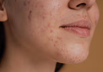 Close-up of a person's cheek and lips showing acne scars and blemishes on the skin.