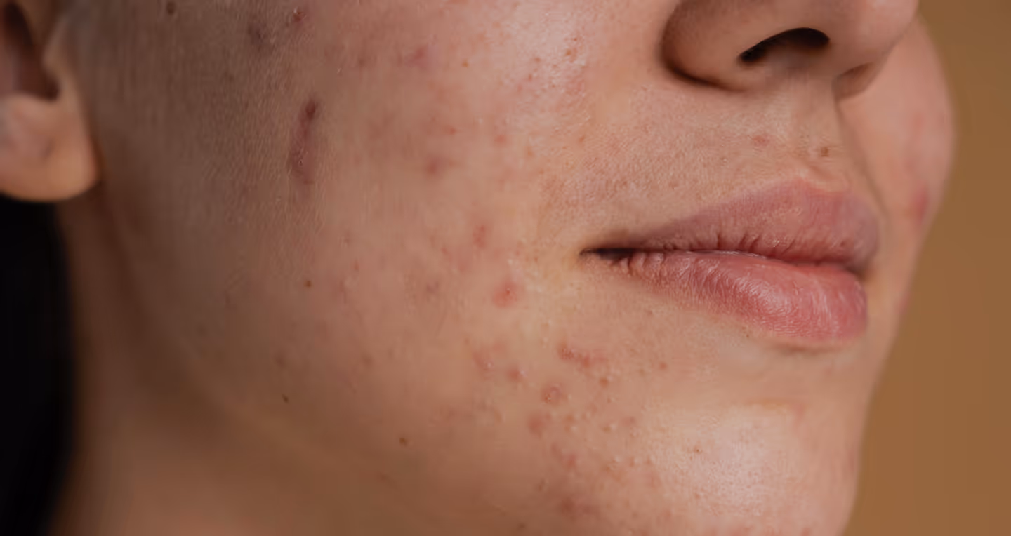 Close-up of a person's cheek and lips showing acne and some healing skin.