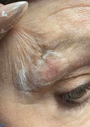 Close-up of a person's forehead with a red, swollen bump near the eyebrow and surrounding skin showing fine lines.