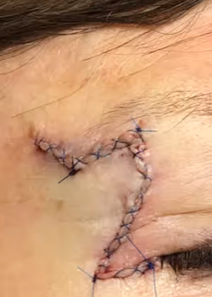 Close-up of a person's forehead and eye area showing a zigzag-shaped stitched surgical wound with visible sutures.