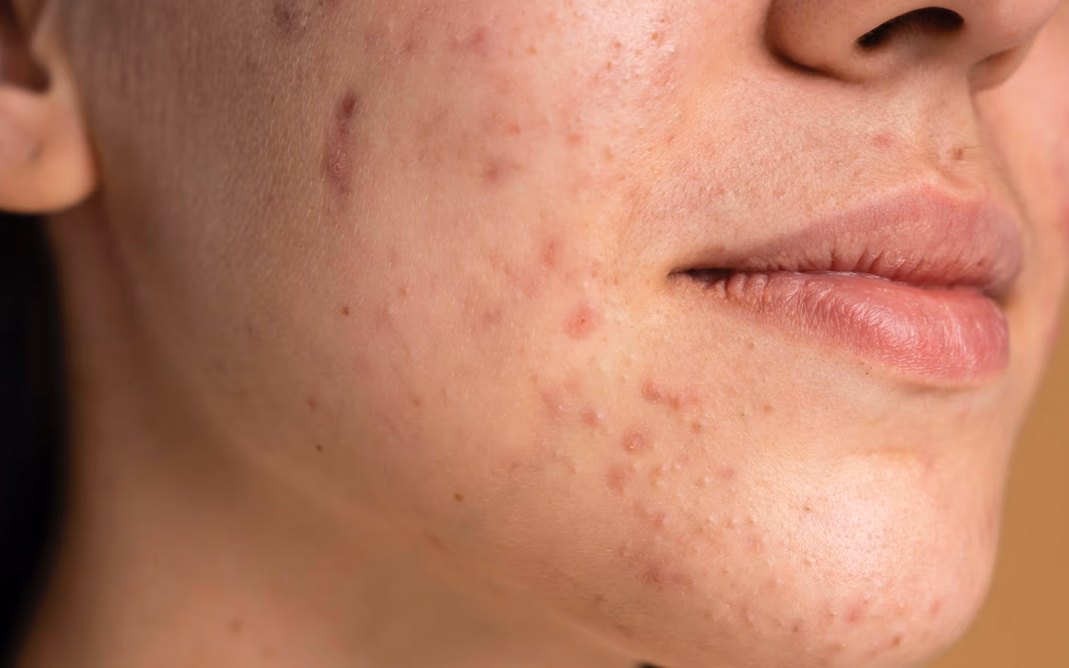 Close-up of a person's cheek and lips showing acne and skin blemishes.