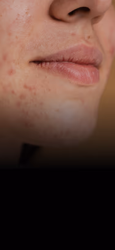 Close-up of a person's lower face showing skin with acne and blemishes around lips and chin.