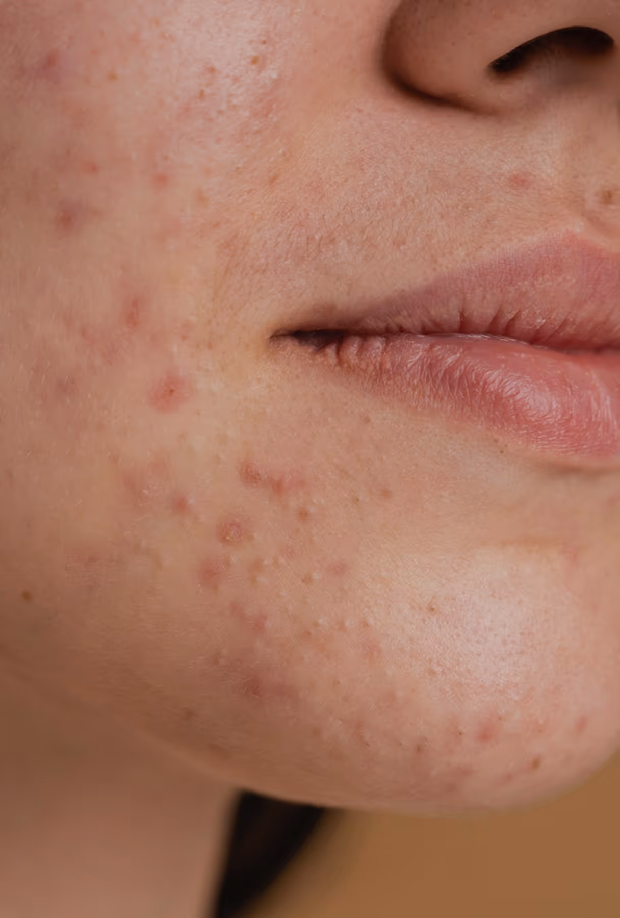 Close-up of a person's lower face showing mild to moderate acne and blemishes on the cheek and chin.