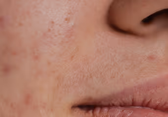 Close-up of a person's cheek and lips showing skin with redness and some acne blemishes.