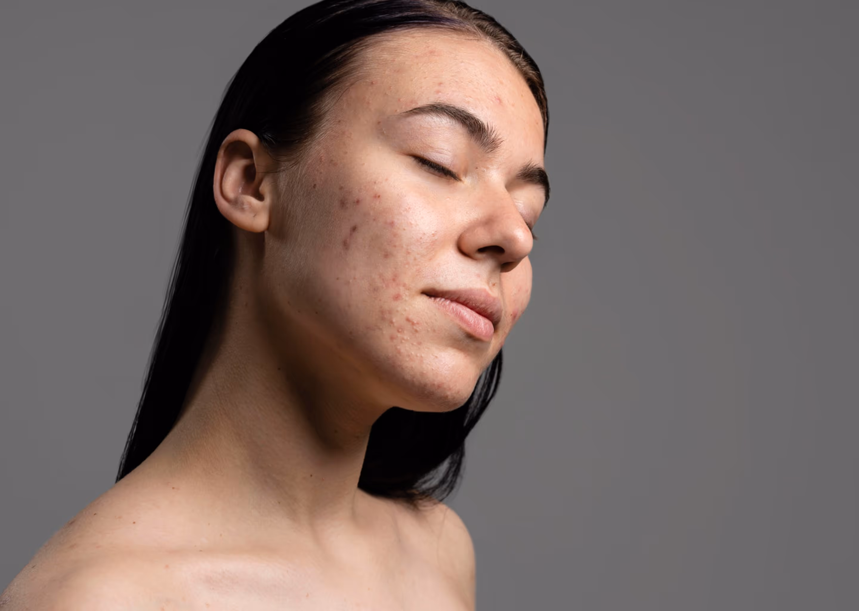 Close-up of a person's lower face and neck with visible acne and red blemishes on the cheek.