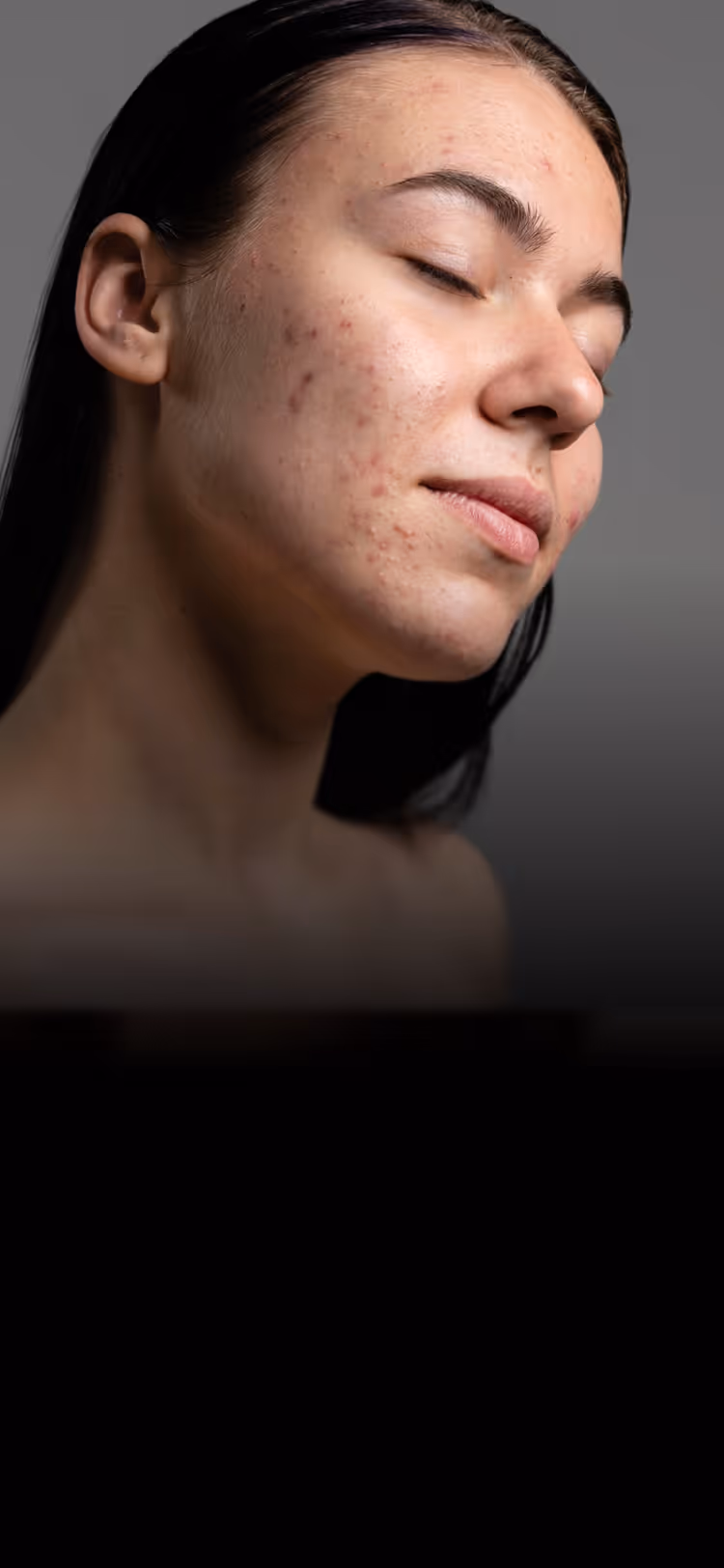 Close-up of a person's lower face and jawline showing acne and scars on the cheek.