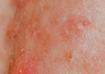 Close-up of human skin with red irritation and inflammation visible.