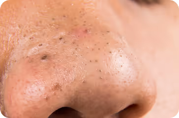 Close-up of a person's nose showing visible blackheads and some blemishes on the skin.