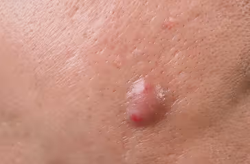 Close-up of a shiny, raised skin blister with a red spot on human skin.