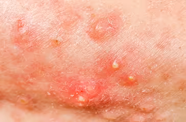 Close-up of skin with red acne pimples and white pus-filled spots on a light skin tone.