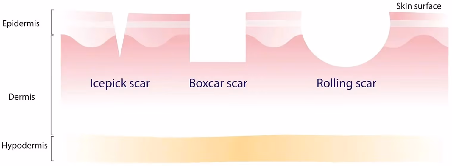 Cross-section diagram of skin showing epidermis, dermis, and hypodermis layers with three types of scars: icepick, boxcar, and rolling scars on the skin surface.