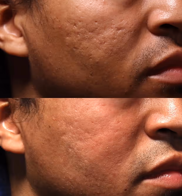 Side-by-side close-up of a man's cheek before and after skincare treatment showing reduced acne scars and smoother skin texture.
