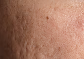 Close-up of skin showing pores, texture, and a small mole.