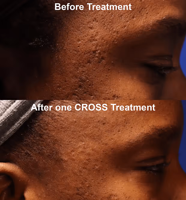 Side-by-side close-up of a person's cheek before and after one CROSS treatment, showing improved skin texture and reduced acne scars.