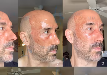 Three side-profile views of a man showing stages of healing brown facial burn scars.