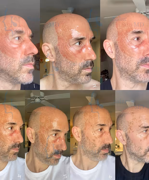 Seven close-up side-view photos of a bald man showing progressive healing of a large, reddish facial scar.