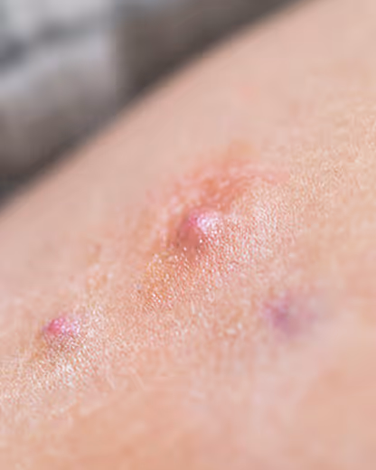 Close-up of inflamed skin with several red, swollen acne pimples.