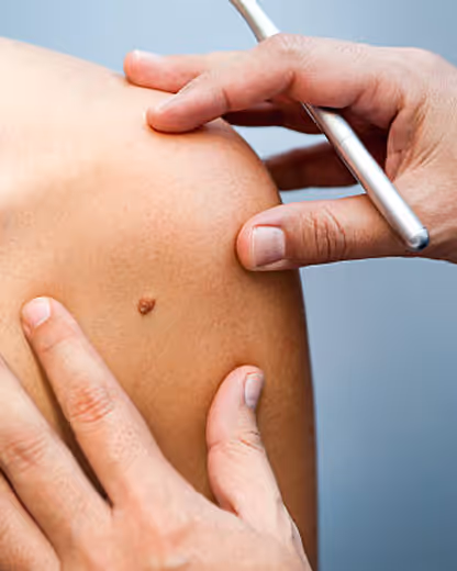 Close-up of a doctor examining a mole on a patient's shoulder with a dermatoscope.