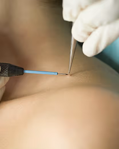 Close-up of medical procedure with gloved hands inserting a needle into skin.