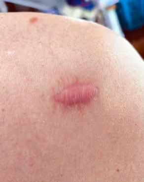 Close-up of a skin lesion with a purple-red raised patch on light skin.
