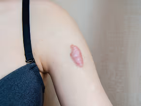 Close-up of upper arm showing a raised, pink scar against light skin.