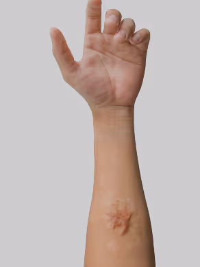 Forearm with a raised scar near the wrist and a partially closed hand against a plain background.