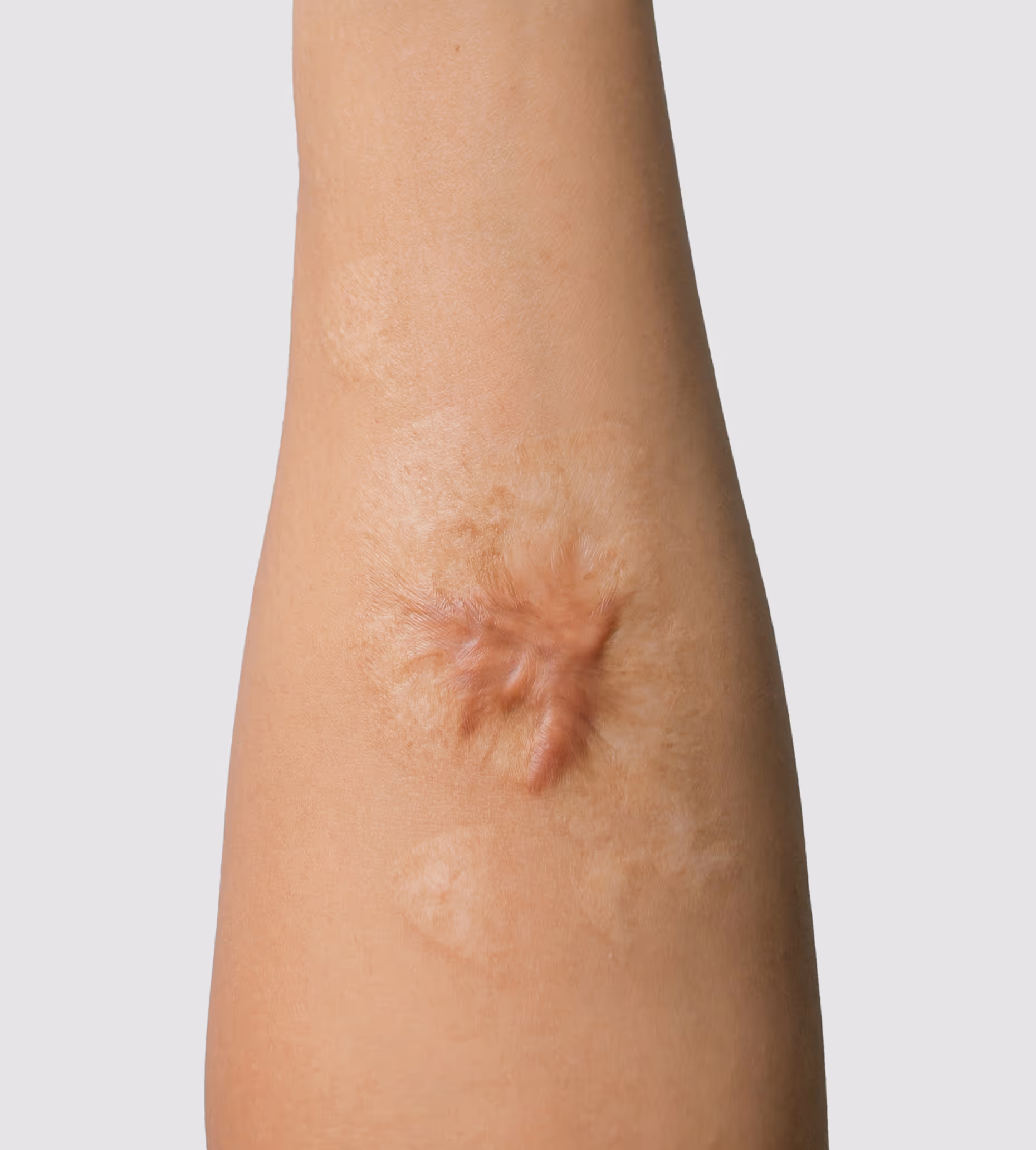 Close-up of a raised, textured keloid scar on a person's forearm with surrounding skin.