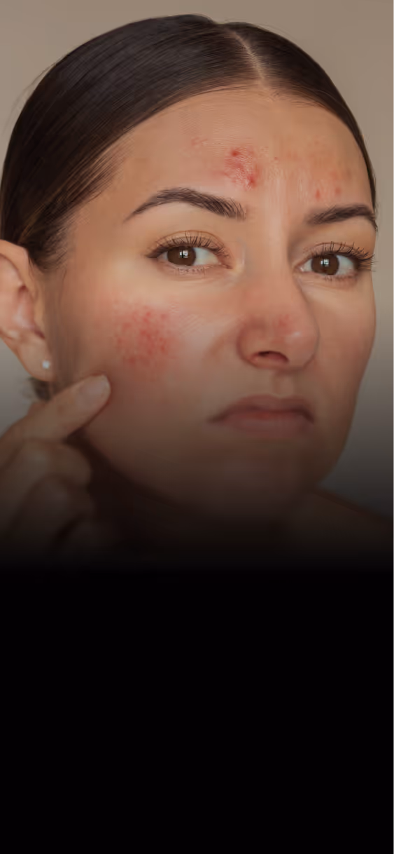 Close-up of a woman with acne on her forehead and cheeks, touching her cheek with a concerned expression.