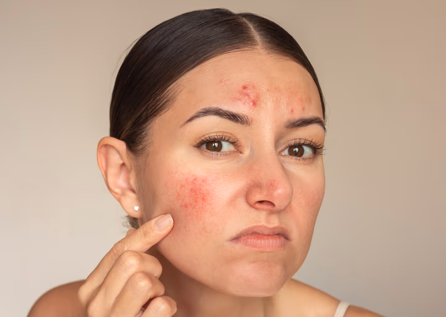 Woman with acne and red irritated skin on her forehead and cheek touching her face.