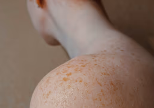 Close-up of a person's shoulder and neck with light skin and freckles.