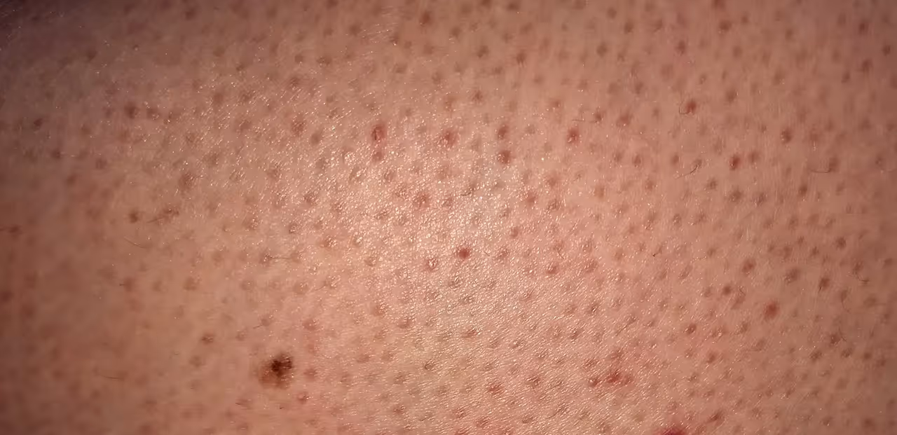 Close-up of human skin with visible pores and some small red spots and a dark mole.