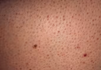 Close-up of skin with visible pores, a mole, and a small red blemish.
