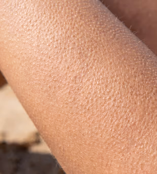 Close-up of human skin with goosebumps.