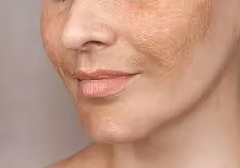 Close-up of a woman's lower face showing smoother skin on one half and textured, uneven skin on the other half.