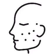 Simple line drawing of a human face in profile with dots on the cheek, indicating acne or skin blemishes.