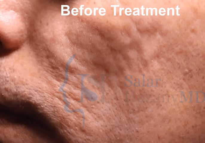 Close-up of cheek with visible acne scars and textured skin labeled 'Before Treatment'.