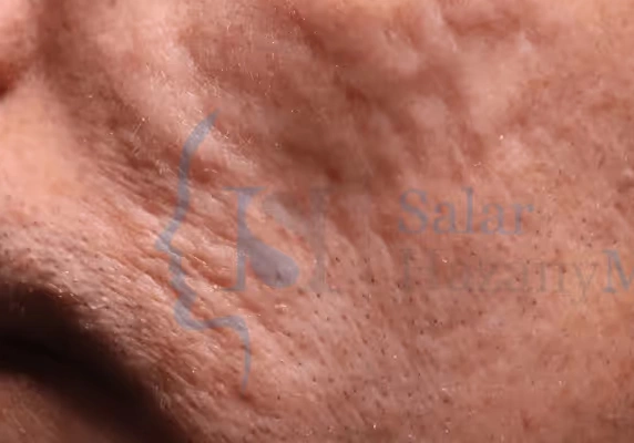 Close-up of cheek with visible acne scars and textured skin labeled 'Before Treatment'.
