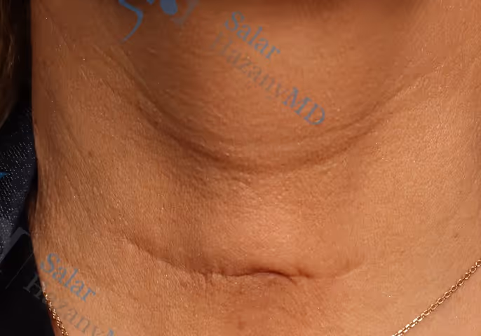 Close-up of neck skin showing a small horizontal scar below the Adam's apple.