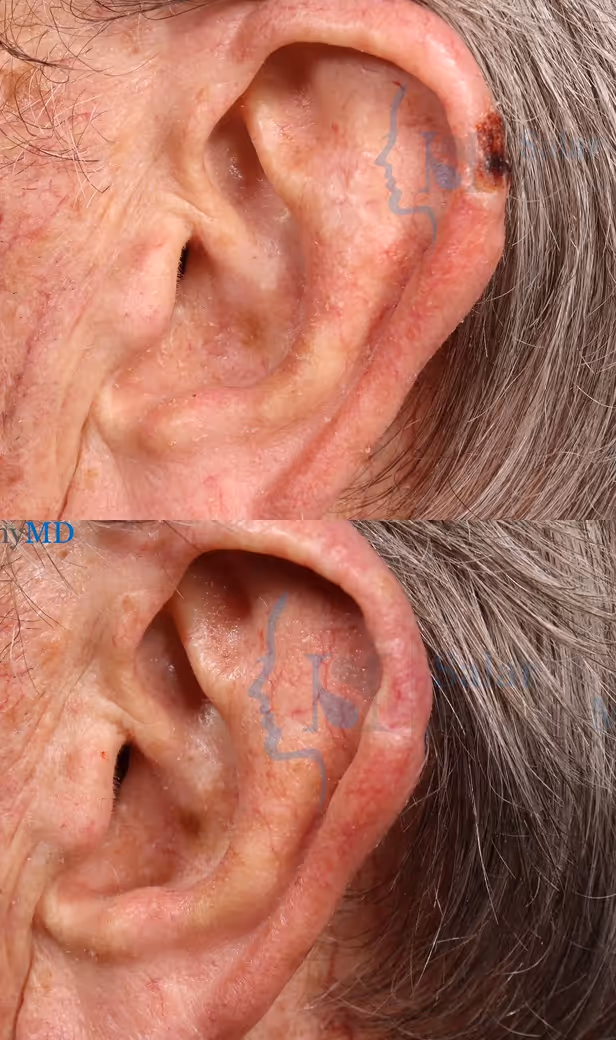 Close-up comparison of an elderly ear before and after treatment of a dark skin lesion on the upper ear.