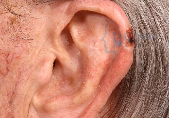 Close-up of an ear with visible red irritated skin and a dark scab near the top.