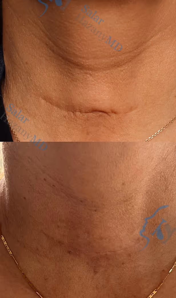 Close-up before and after images of neck with improved skin texture and reduced wrinkles.