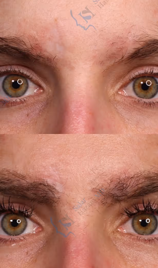 Close-up of a person’s eyes and forehead showing sparse eyebrows in the top image and fuller eyebrows in the bottom image.