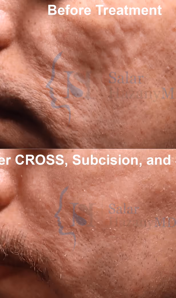 Close-up before and after images showing reduced acne scars and smoother skin texture on a man's cheek.